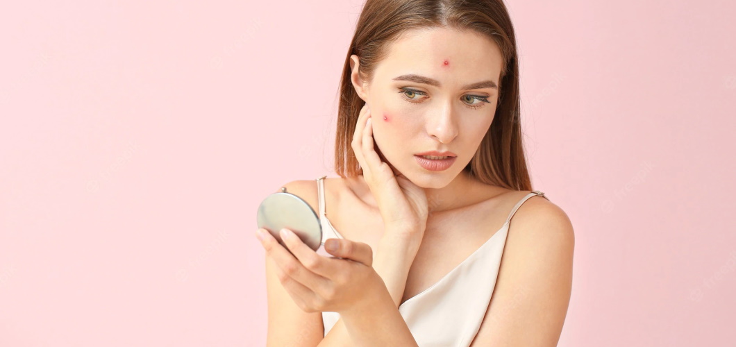 Korean Skincare Tips for Acne Prone Skin